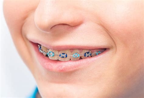 Braces for Children's Teeth - Cost, Types and more