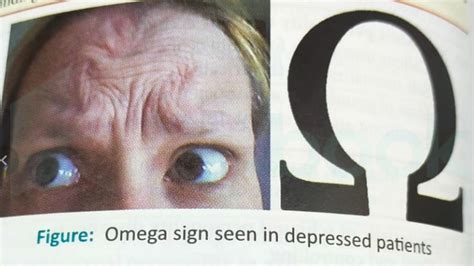 [Solved] 'Omega sign' is seen in which of the following?