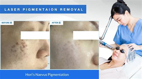 QCS laser has been effective in treating Hori's nevus pigmentation ...