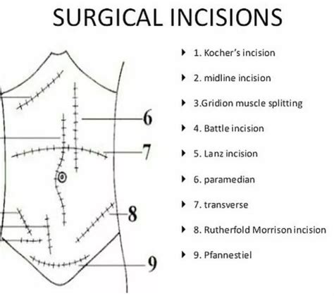 Surgical incisions - MEDizzy