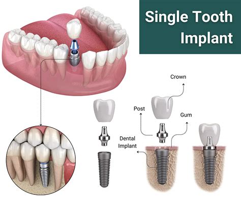 Single Tooth Implant in NJ - Riverside Oral Surgery