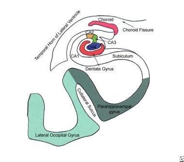 Imaging in Mesial Temporal Sclerosis (Temporal Lobe Epilepsy): Practice Essentials, Computed ...