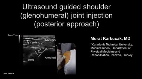 Glenohumeral Joint Injection Ultrasound