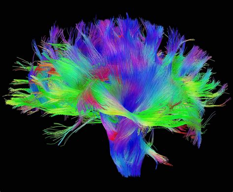 MRI of the brain using Diffusion Tensor Imaging (DTI) analysis. : pics