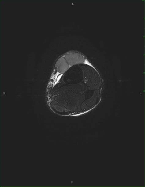 Spindle Cell Sarcoma, Leg - Musculoskeletal Case Studies - CTisus CT Scanning