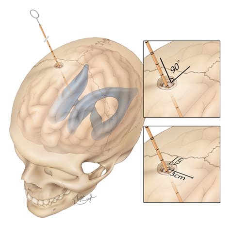 External Ventricular Drain | The Neurosurgical Atlas, by Aaron Cohen ...