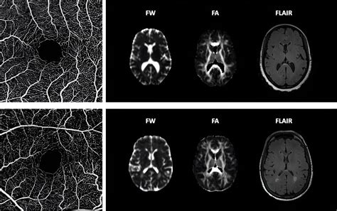 Study Discovers Possible Tool To Diagnose Common Contributor To ...