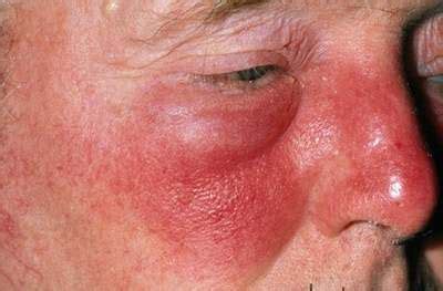 Erysipelas - Causes, Pictures, Treatment, Infection, Symptoms.