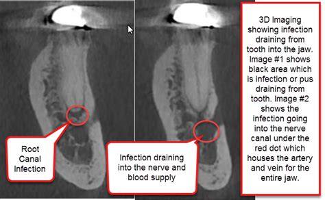 Hidden Root Canal Infections - How We Uncover Long Standing Infections ...