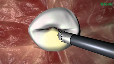 Endoscopic Mitral Valve Repair Procedure Animation - YouTube