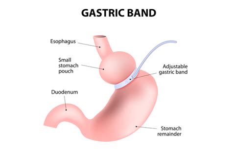 Gastric Banding - Dr. Mario Camelo