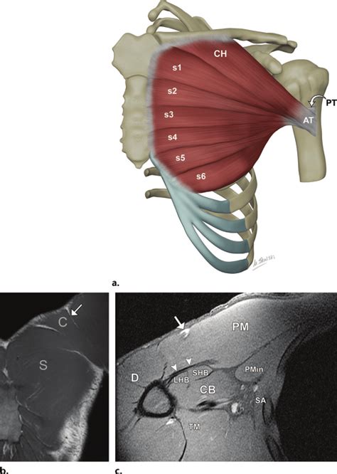 Normal anatomy of the pectoralis major muscle. (a) The pectoralis major... | Download Scientific ...
