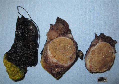 Gross description | Pathology dictionary | MyPathologyReport.ca