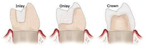 What is the difference between inlay, onlay, overlay and pinlay? | News ...