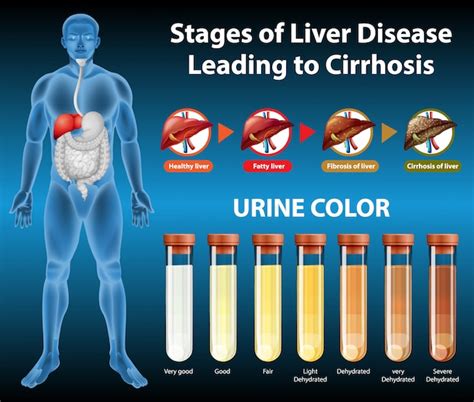 Liver Disease Progression Chart