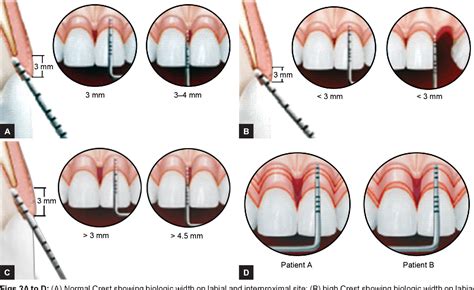 Figure 2 from Biologic Width : An Important Link between Periodontics and Restorative Dentistry ...