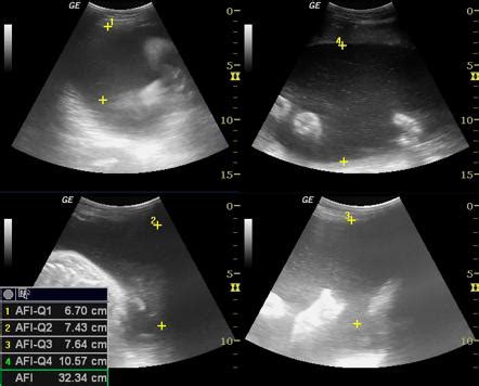 Amniotic Fluid Index