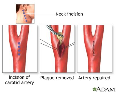 Carotid artery surgery | Multimedia Encyclopedia | Health Information ...