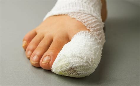 Trench Foot - Pictures, Symptoms, Treatment, Home Remedies