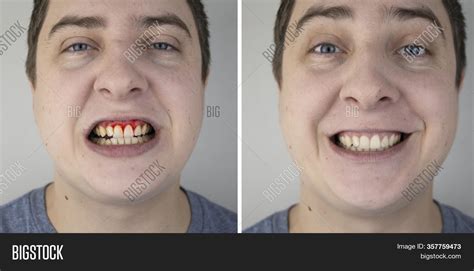 Gingivitis Before And After