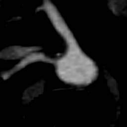 Renal artery stenosis MRI - wikidoc