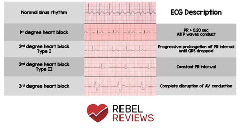 Pin by Taylor Krom on Med-Surg in 2021 | Heart blocks, Heart block poem ...