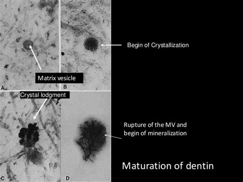 dentin pattern of mineralization, 1ry 2nd 3ry dentin formation and ro…