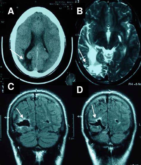 Medial Occipital Lobe