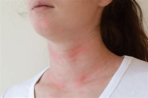 What is chronic urticaria?