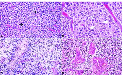 6: Anaplastic oligodendroglioma A Typical image of a cellular glioma... | Download Scientific ...