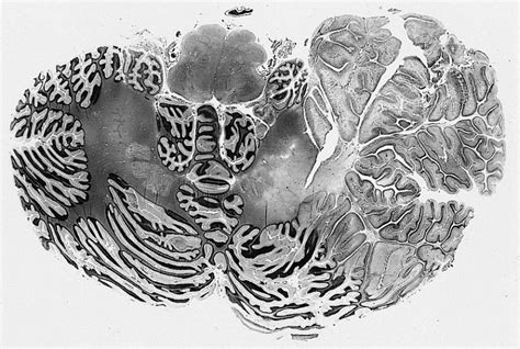 Lhermitte-Duclos disease - wikidoc