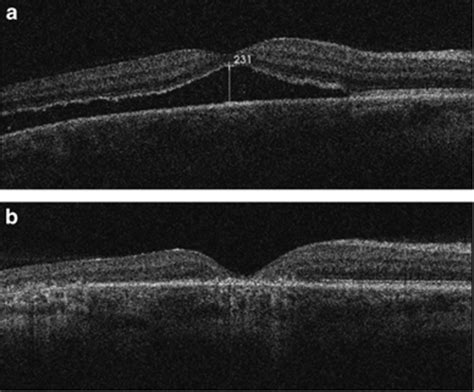 OCT scans for the same patient with chronic retinal detachment ...