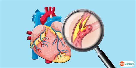 Risk Factors With Arteriosclerosis Archives - GoMedii Blog