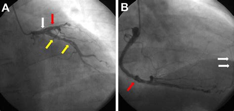 Left and right coronary angiogram. (A) Left coronary angiogram... | Download Scientific Diagram