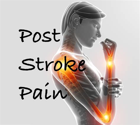 Post Stroke Pain: Diagnosis and Treatment - Rehab HQ