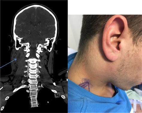 Sternocleidomastoid muscle pain: Cause, Symptoms, Treatment, Exercise ...