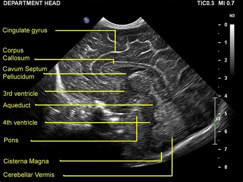 Neonatal Cranial Ultrasound Anatomy