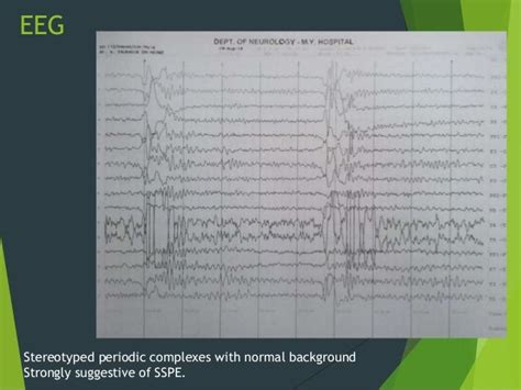 SSPE, myasthenia n LETM