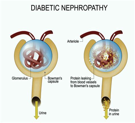 Diabetic Nephropathy - Symptoms Pathophysiology Treatment - Dr. Nikhil ...