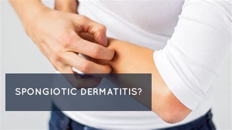 Spongiotic Dermatitis: Symptoms, Treatment & Prevention