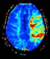 Perfusion MRI - Wikipedia