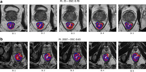 MRI-based radiomics to predict response in locally advanced rectal ...