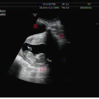 Ultrasonography of the retroverted gravid incarcerated uterus in the... | Download Scientific ...