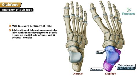 Club Foot | Congenital Talipes Equinovarus | Talipes Equinus | Talipes ...