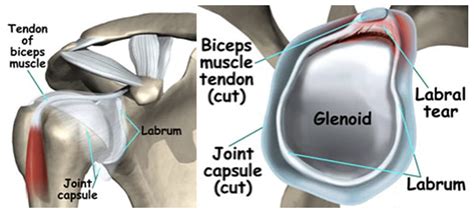 Anatomy Shoulder Labrum Tear