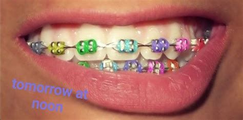 Braces Teeth Colors, Cute Braces Colors, Teeth Braces, Braces Humor, Rainbow Braces, Braces ...