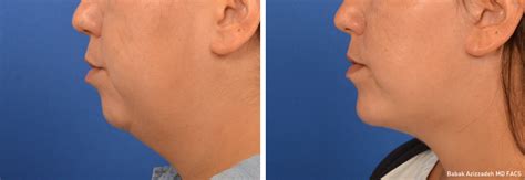 Double Chin Surgery - Chin Liposuction | CENTER | CENTER