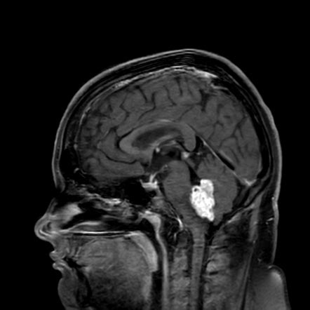 Choroid plexus papilloma | Radiology Case | Radiopaedia.org