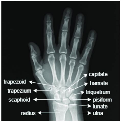 The anatomy of the wrist. | Download Scientific Diagram