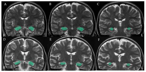 Microorganisms | Free Full-Text | Hippocampal Atrophy in Pediatric Transplant Recipients with ...